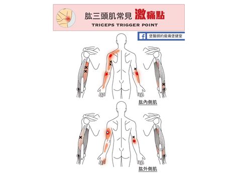 骨節手|手肘痛、手腕痛、手指痛的原因,治療與自我檢查 » 台。